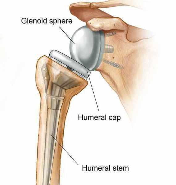 Shoulder replacement