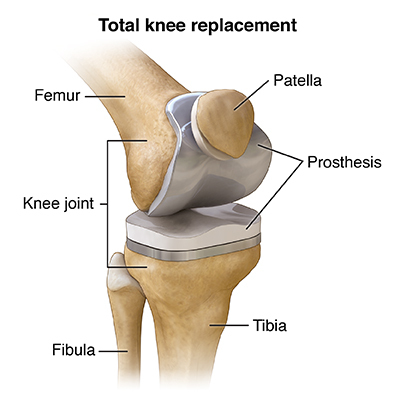 Total Knee Replacement