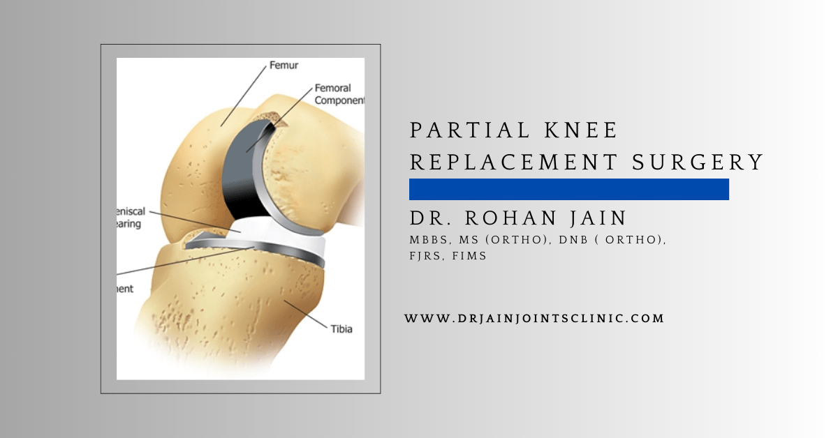 Partial Knee Replacement Surgery in Jaipur Dr. Rohan Jain (FJRS, FIMS)