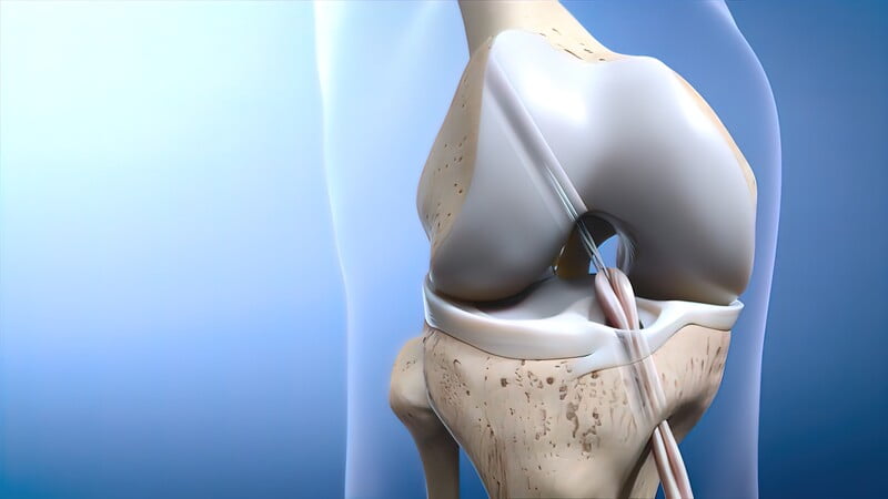  ACL Tear