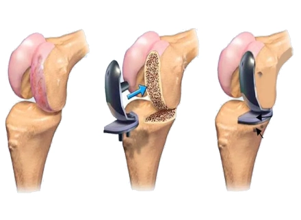 Advantages of Knee Replacement Surgery