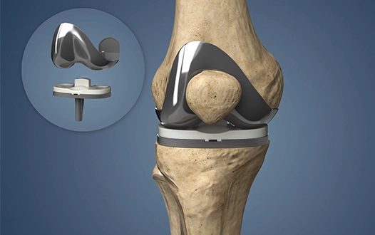 What should I do after total knee replacement?