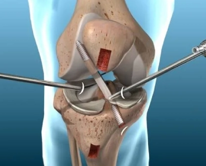 https://www.drjainjointsclinic.com/wp-content/uploads/2024/04/knee-arthroscopy-surgery.webp