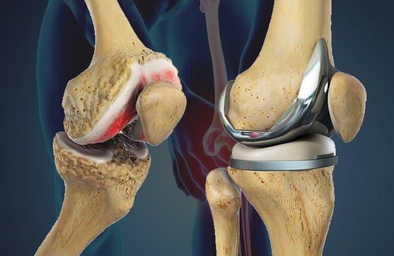 https://www.drjainjointsclinic.com/wp-content/uploads/2024/04/totalkneereplacement.jpg